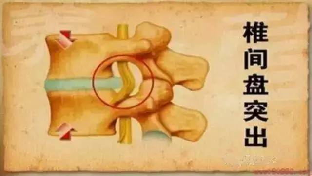 腰椎间盘突出症都有哪些原因,以及如何用无限极产品调理