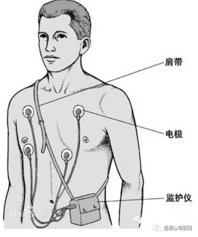 在常态情况下长时间(24-72小时)监测体表心电变化的心电图