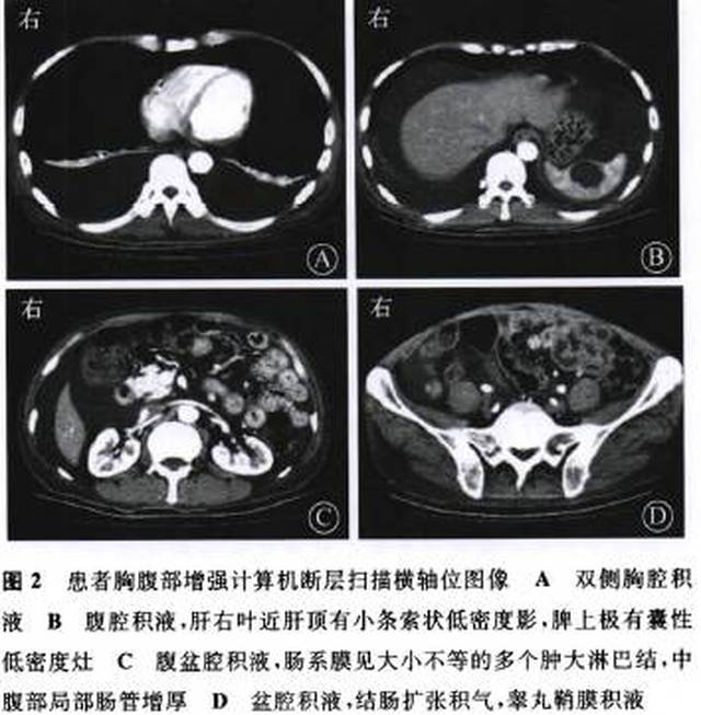 腹部超声检查:①腹盆腔积液(中至大量);②脾囊肿可能,肝,胆,胰,双肾