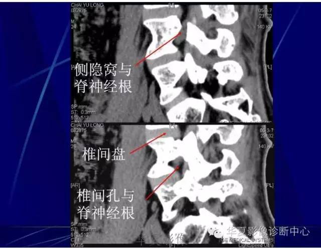 详细的腰椎解剖,椎间盘突出,膨出,看这里