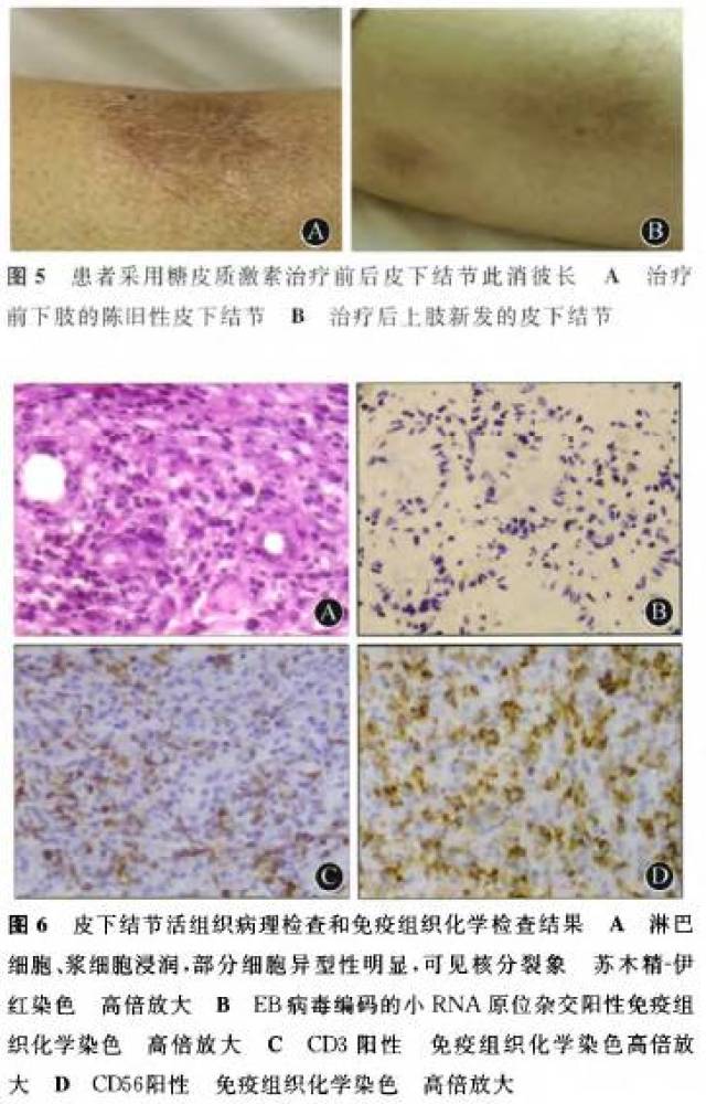 伴随着患者临床症状的好转,仔细体格检查却发现患者四肢皮下结节此消