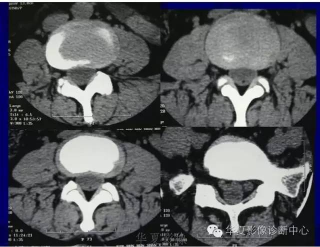 详细的腰椎解剖,椎间盘突出,膨出,看这里