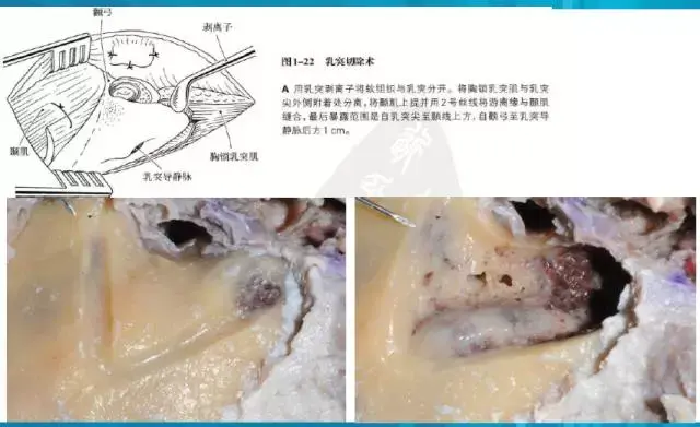 颞下窝入路b型解剖