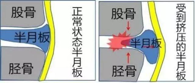 膝关节内有一个重要的解剖结构叫半月板.