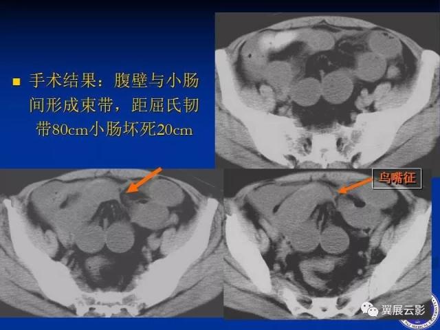 急性绞窄性肠梗阻ct诊断