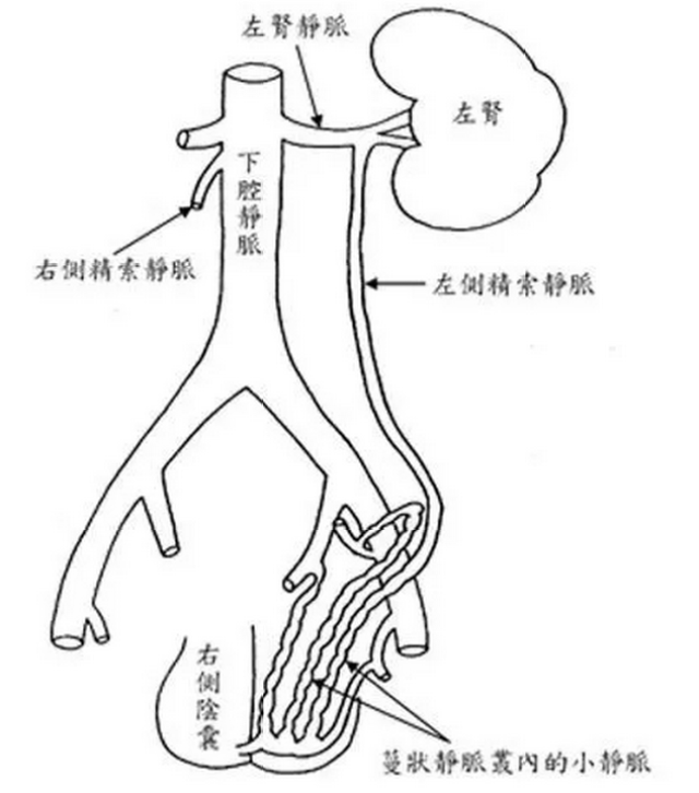 精索静脉曲张——这个男性健康"杀手"你了解吗?