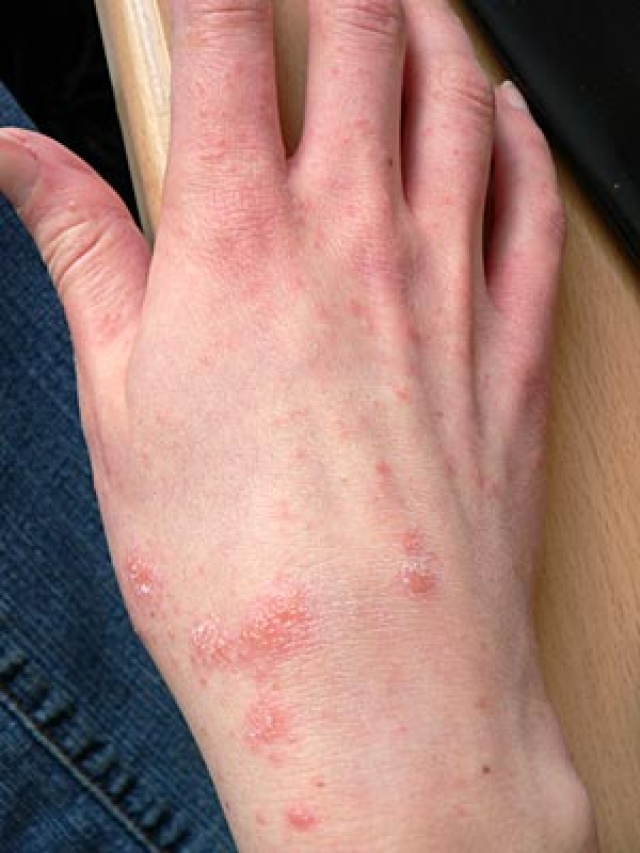 但是疥疮常见于胳膊和大腿,最常见的症状为瘙痒.