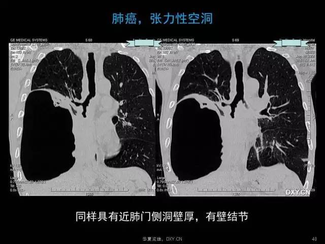 w  站友  @华夏览雄 就来和你聊聊 「肺炎,肺癌,肺结核在 ct 及胸片上