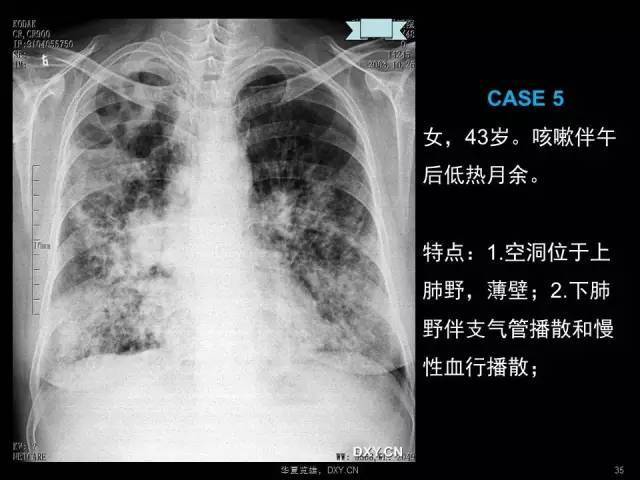 读片秘籍:肺癌,肺炎,肺结核的鉴别-健康频道-手机搜狐