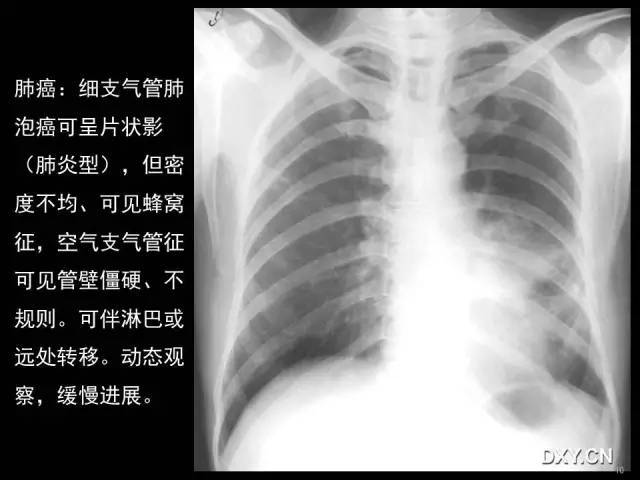 读片秘籍:肺癌,肺炎,肺结核的鉴别