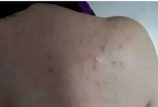 背后长了很多的"小米粒", 里面出来一个硬硬的,知道真相后惊呆了!