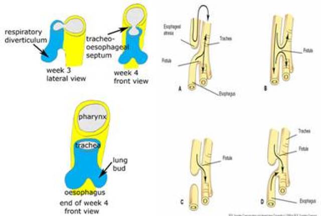 食管腔开始形成间隔(左图);若此时出现发育异常则可形成先天性喉裂