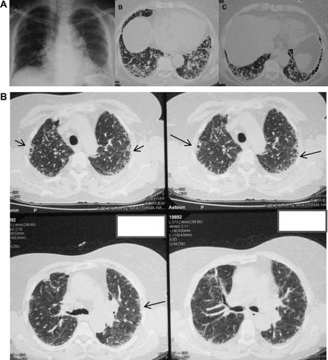 继而行胸腔ct扫描,结果显示双侧坏死性和结节性病灶,其中部分有空洞.