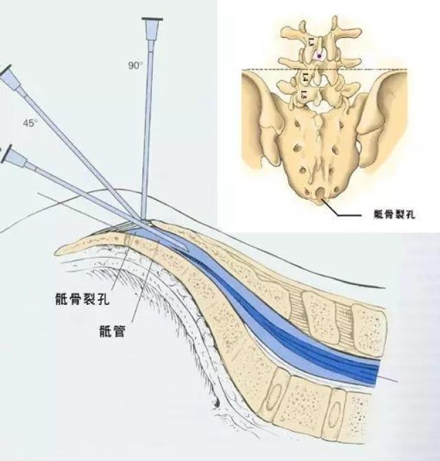 啥叫骶管麻醉?扎哪儿啊