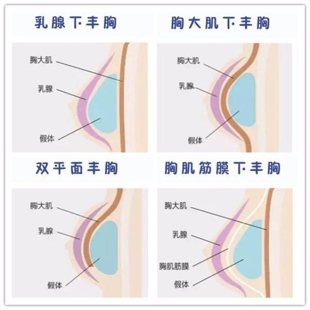 【揭秘】关于假体隆胸手术那些事儿(二):假体置入位置