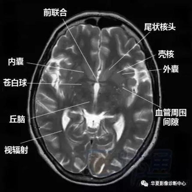 脑部断层 内囊 willis环 前联合 垂体 海马:清晰解剖图谱