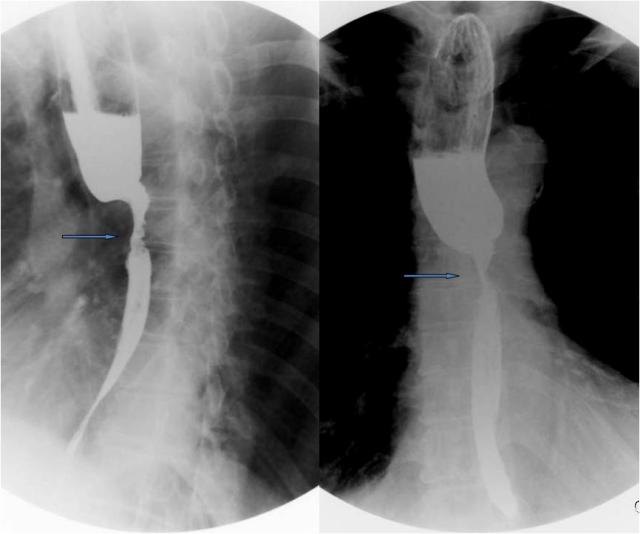 同样的吃饭困难,这两个病人做钡餐,都出乎意料,一个如