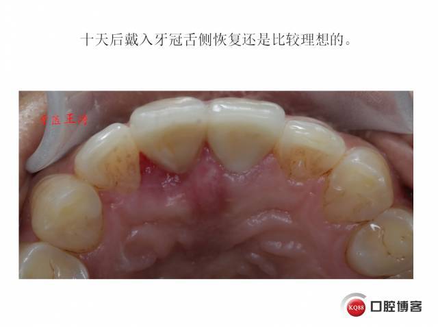 前牙外伤冠延长 全瓷冠修复