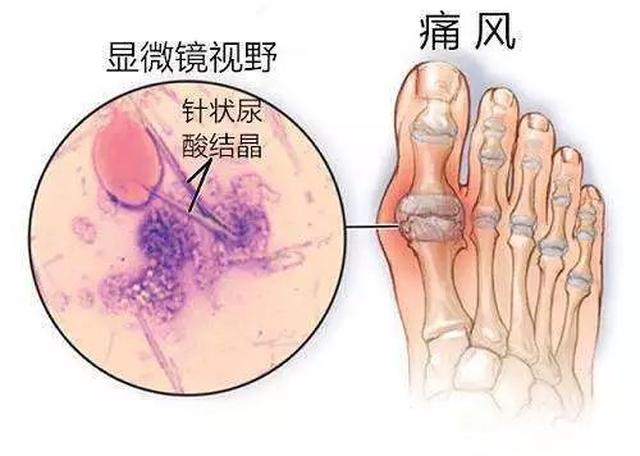 如果血液里溶解的尿酸浓度超过饱和点,它们就会形成尿酸盐结晶,沉积在