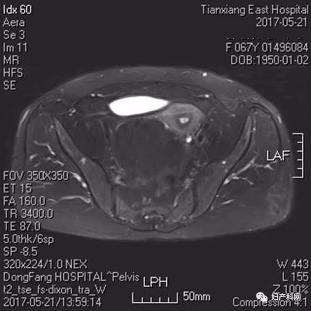 妇检:外阴已婚经产式.