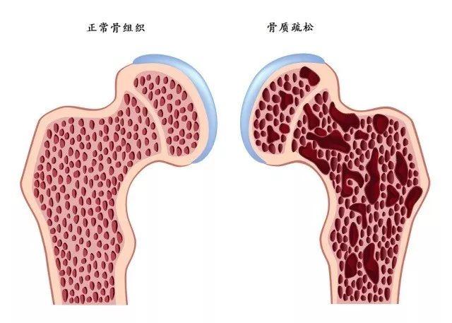 骨质疏松属于全身性代谢性骨病,是一种由于骨量减少,骨密度降低引起的