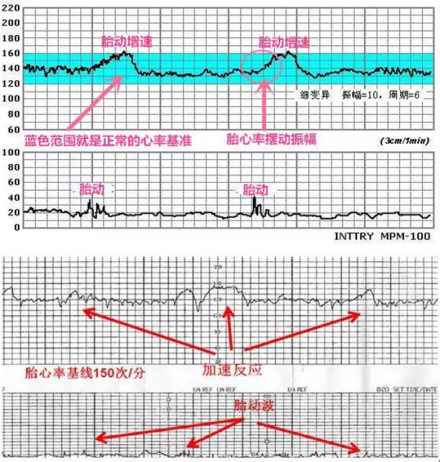 "胎心监护"很重要,直接反映胎儿是否正常!