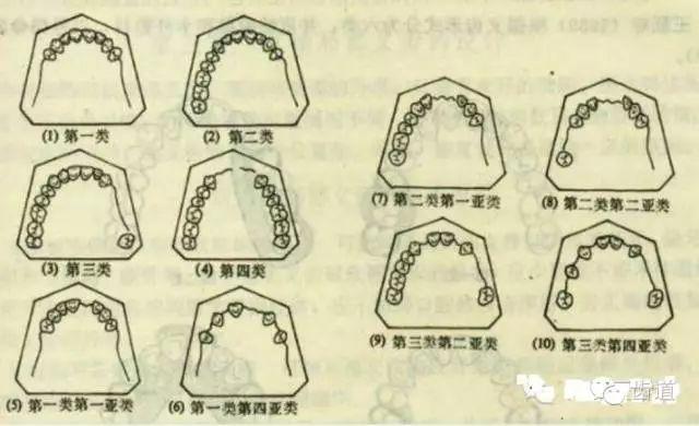 二,肯氏分类的注意点: 1,第四类为单缺隙,无亚类,其余三类均按照除