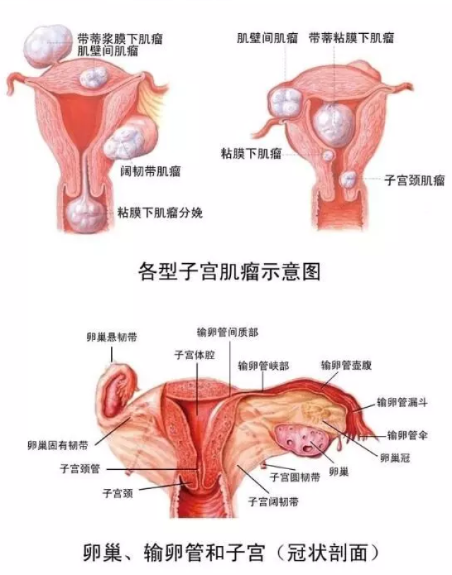 如果肌瘤过大或是肌瘤占据了受精卵着床的位置导致其无法着床.