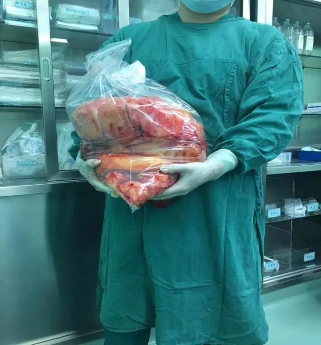 " 望着手术取出的20斤重脂肪肉瘤,宁波鄞州二院副院长洪晓明很是惊讶.