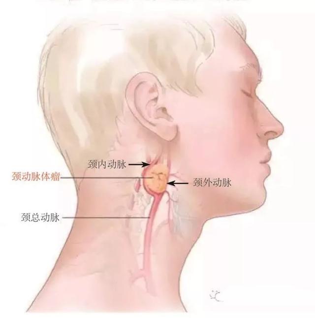 拆弹实录 | 广西患者辗转求医 日前在我院成功切除颈动脉上的"马蜂窝"