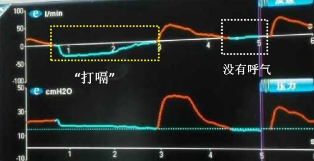 这「锅」该谁背?搞定这些呼吸波形思路就清晰啦
