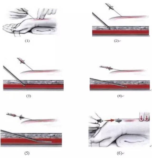 盲法桡动脉穿刺,深度解析!