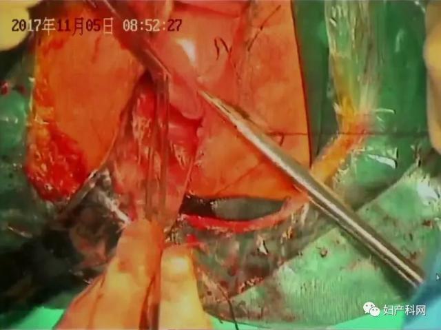 病例2:阴式全子宫切除 双侧附件切除 部分阴道封闭 会阴体修补 膀胱镜