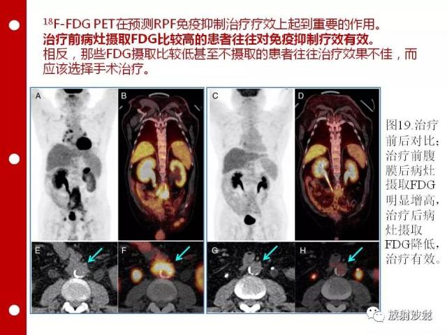 pet-ct 病案讨论 腹膜后纤维化影像学特点(ct,mri)