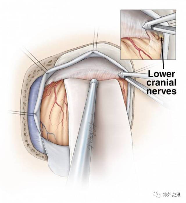 乙状窦后入路切除听神经瘤手术策略与技巧丨the neurosurgical atlas