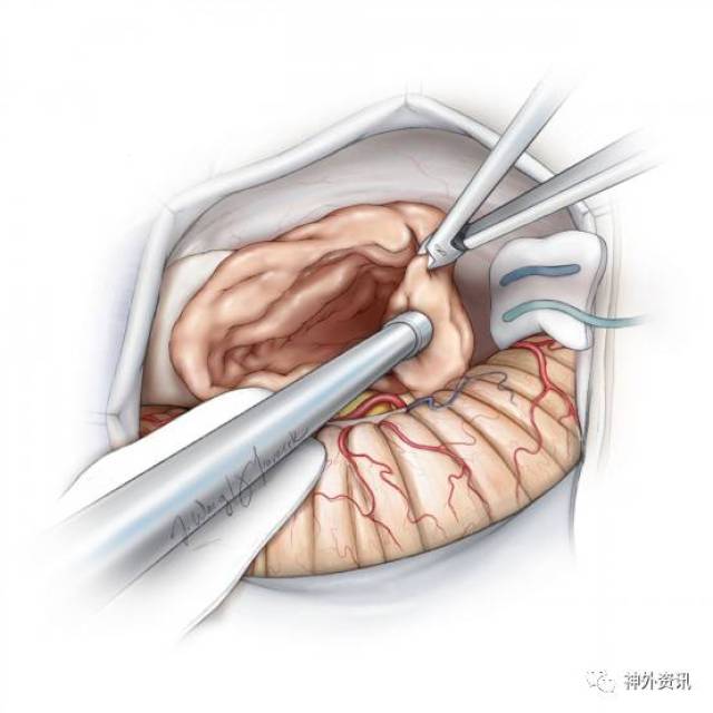 软脑膜层面存在时, 深入地内减压肿瘤和严格止血是听神经瘤手术高效