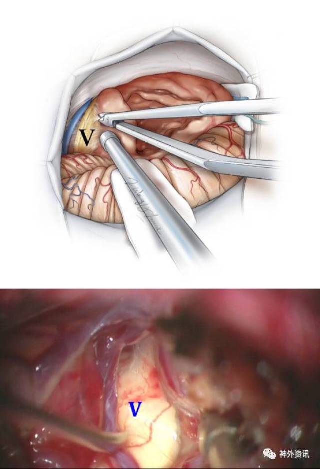 乙状窦后入路切除听神经瘤手术策略与技巧丨the neurosurgical atlas