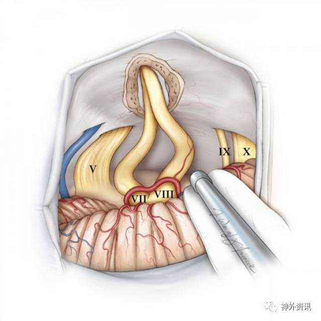 乙状窦后入路切除听神经瘤手术策略与技巧丨the neurosurgical atlas