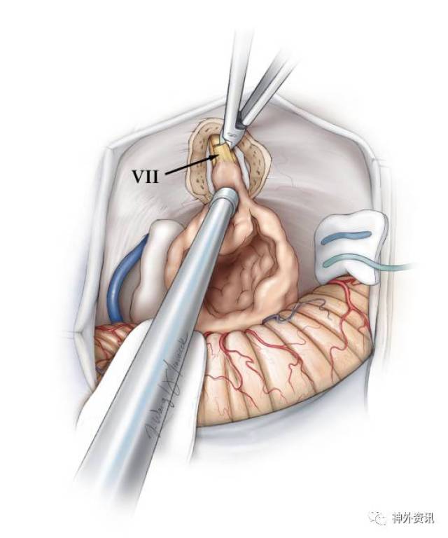 乙状窦后入路切除听神经瘤手术策略与技巧丨the neurosurgical atlas