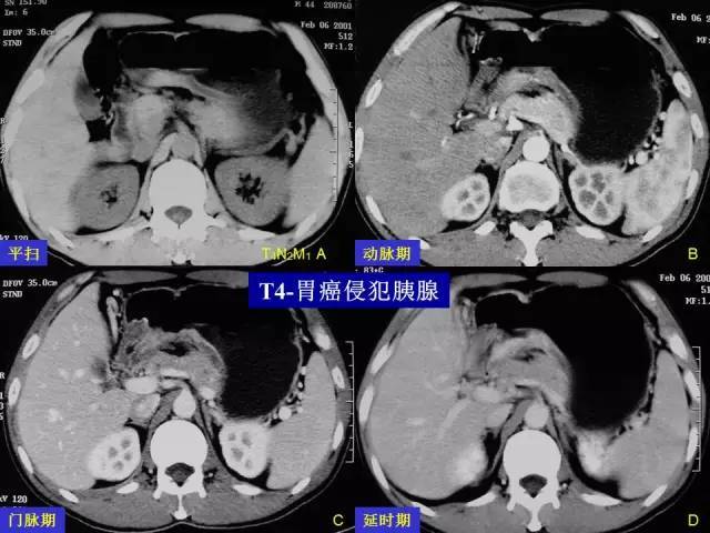 看了这篇 晋级胃癌 ct 诊断高手