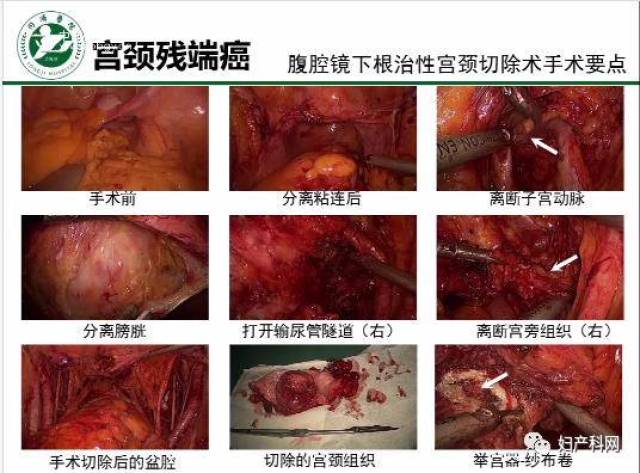 102 汪辉教授:宫颈残端癌的临床特征及