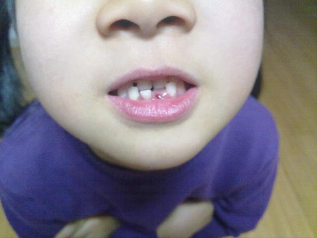 在儿科,经常会碰到家长指着自家孩子的牙齿问:"孩子的恒牙长出来了