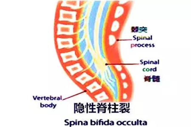 隐性脊柱裂都不需要手术治疗吗?