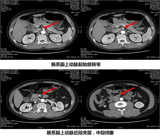 图6. 腹主动脉增强ct见肠系膜上动脉起始部狭窄,近段夹层,中段闭塞