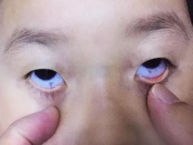 李会娟医生解答:这是结膜色素性病变,可以把它当成眼白长了痣,绝大