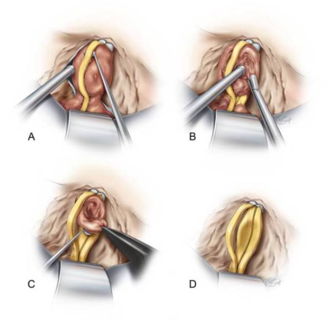 中颅底入路切除听神经瘤手术策略与技巧 | the neurosurgical atlas