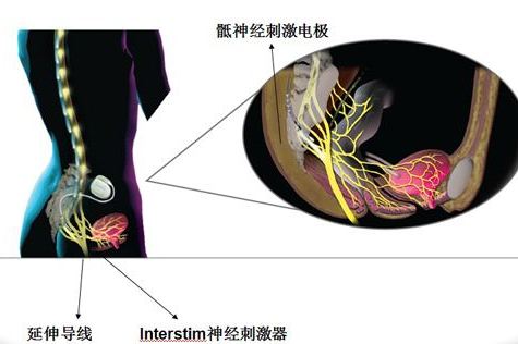 膀胱起搏器图片图片