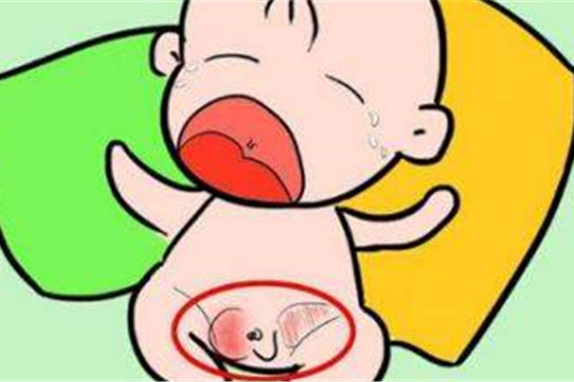 女宝宝腹股沟疝气图片图片