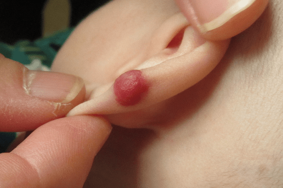 耳鼻咽喉头颈部血管瘤和脉管畸形的治疗方法较多《血管瘤论坛》