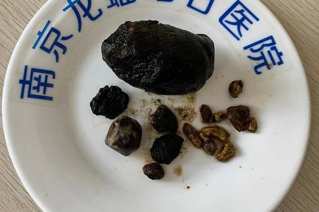 龙蟠微创保胆取出巨大胆结石!专家提醒:胆结石预防应从生活点滴做 !!